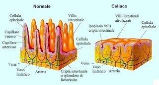 La Celiachia: molto più di una semplice intolleranza